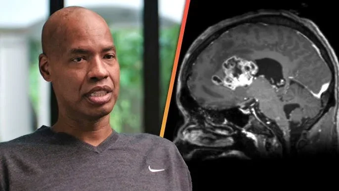 Así descubrió Jason Collins que tenía un tumor cerebral: 